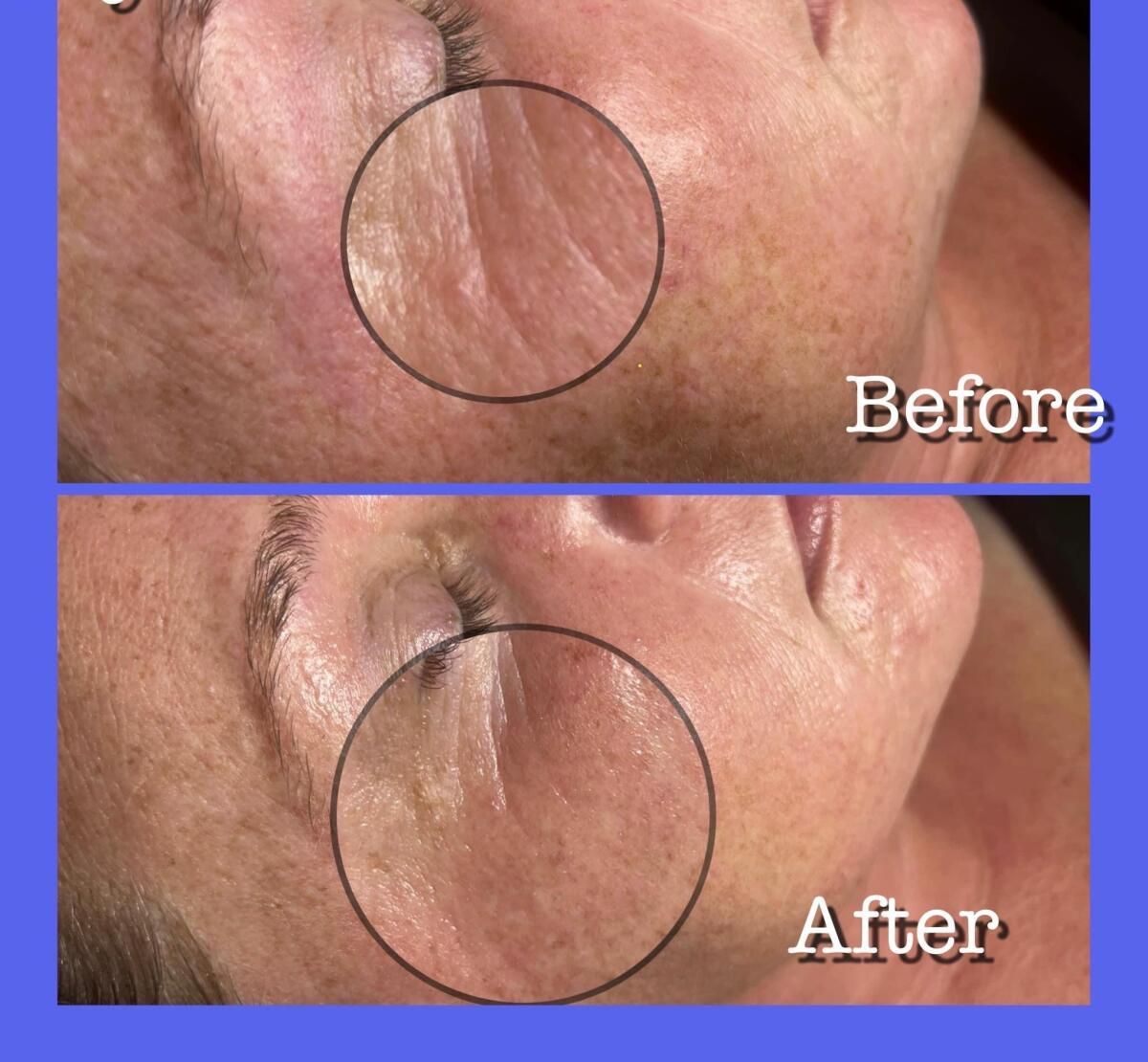 Before and after facial skin comparison. Wrinkles reduced around the eye after treatment.