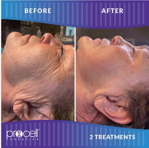 Side-by-side comparison: face with wrinkles (before) smoother face (after) receiving two Procell Therapeutics treatments.