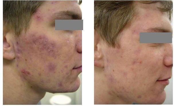 Before-and-after photos of a person's cheek showing improved acne condition. Right side has less redness and scars.