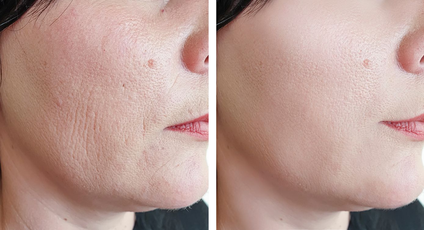 Side-by-side comparison of a person's face. Left shows visible pores and texture. Right shows smooth skin.
