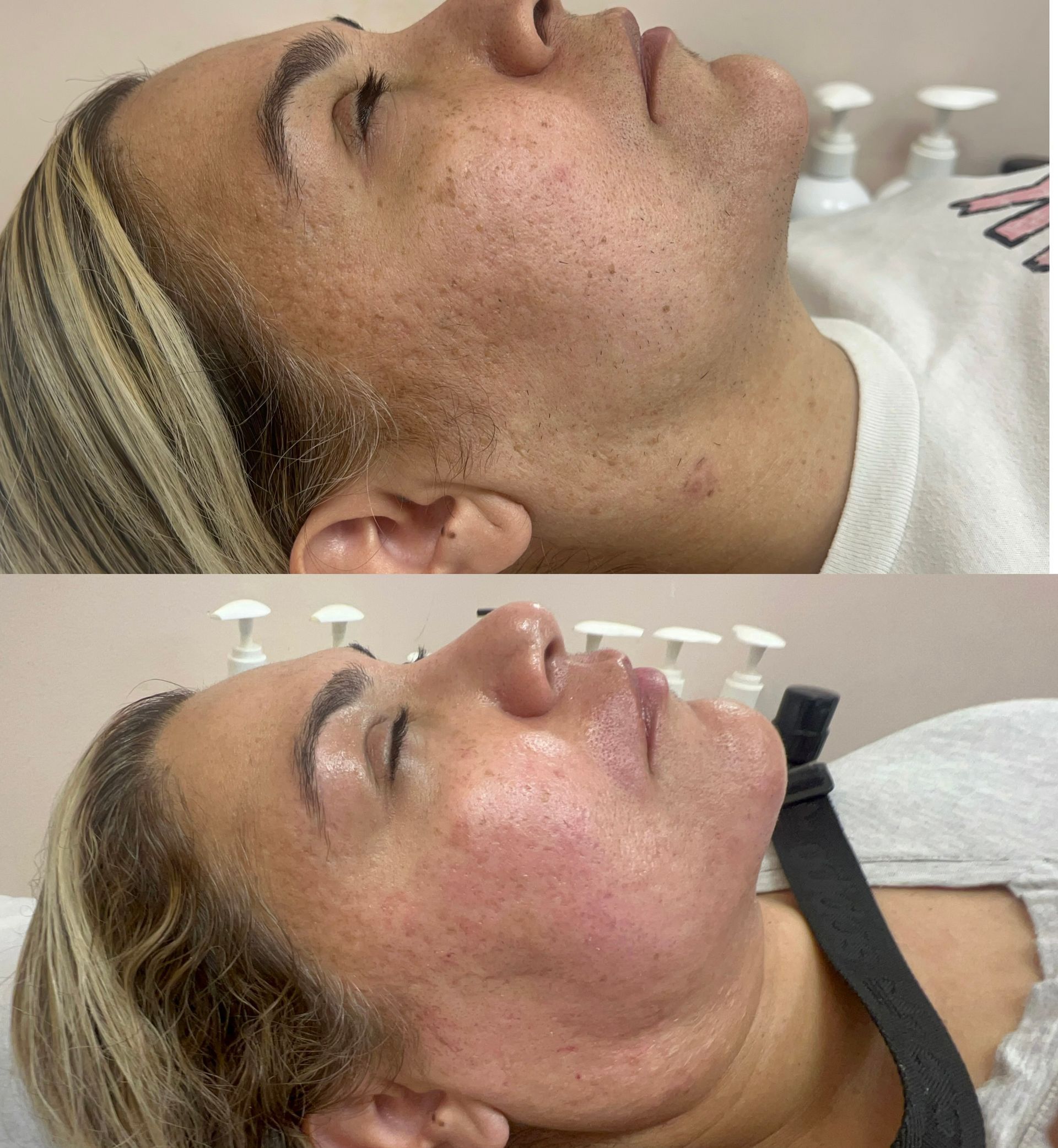 Before-and-after facial treatment showing a person’s skin. The top image shows the skin before; the bottom, after treatment.