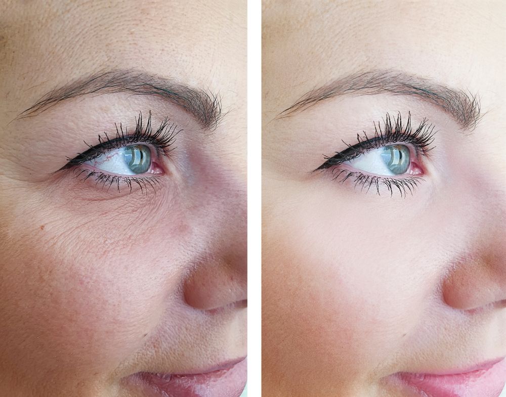 Side-by-side comparison of a person's face. Left side shows wrinkles; right side shows smooth skin.