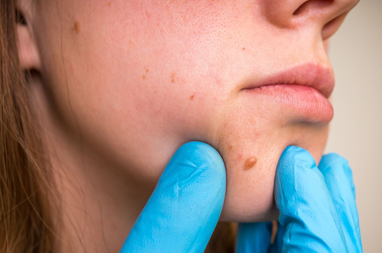 A person's chin with a skin growth being touched by a gloved hand.