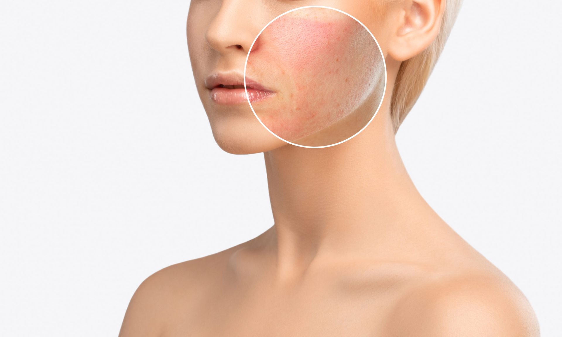 Woman with highlighted red skin on cheek; possible skin condition.