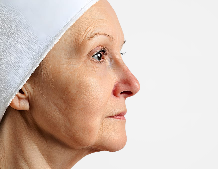 Facelift