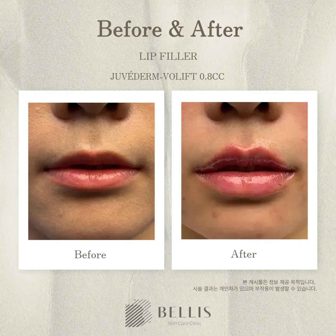 Lip filler before and after at Bellis Clinic