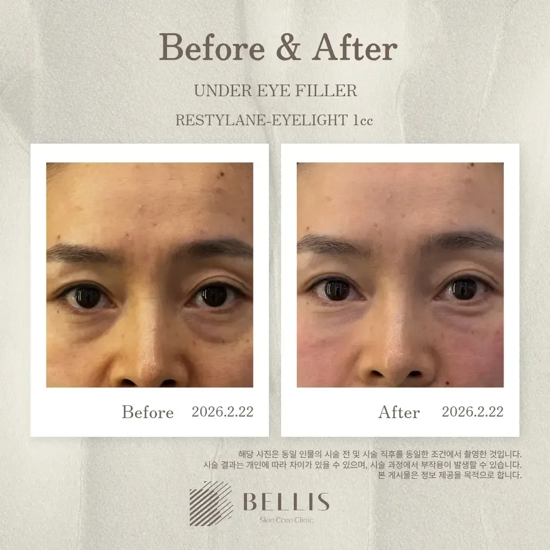 Under-eye filler before and after at Bellis Clinic