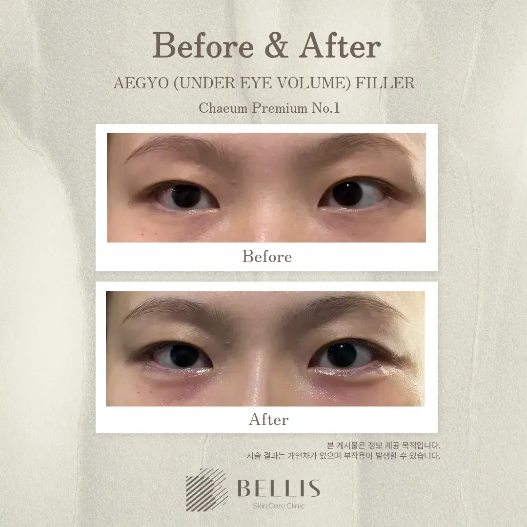 Aegyo-sal and under-eye filler frontal view at Bellis Clinic