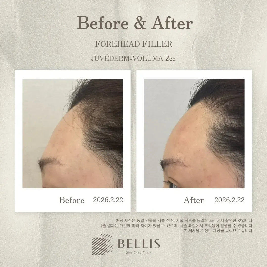 Forehead filler before and after at Bellis Clinic