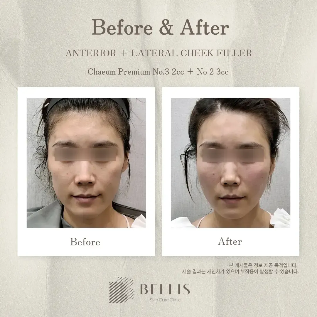 Cheek and temple filler before and after at Bellis Clinic