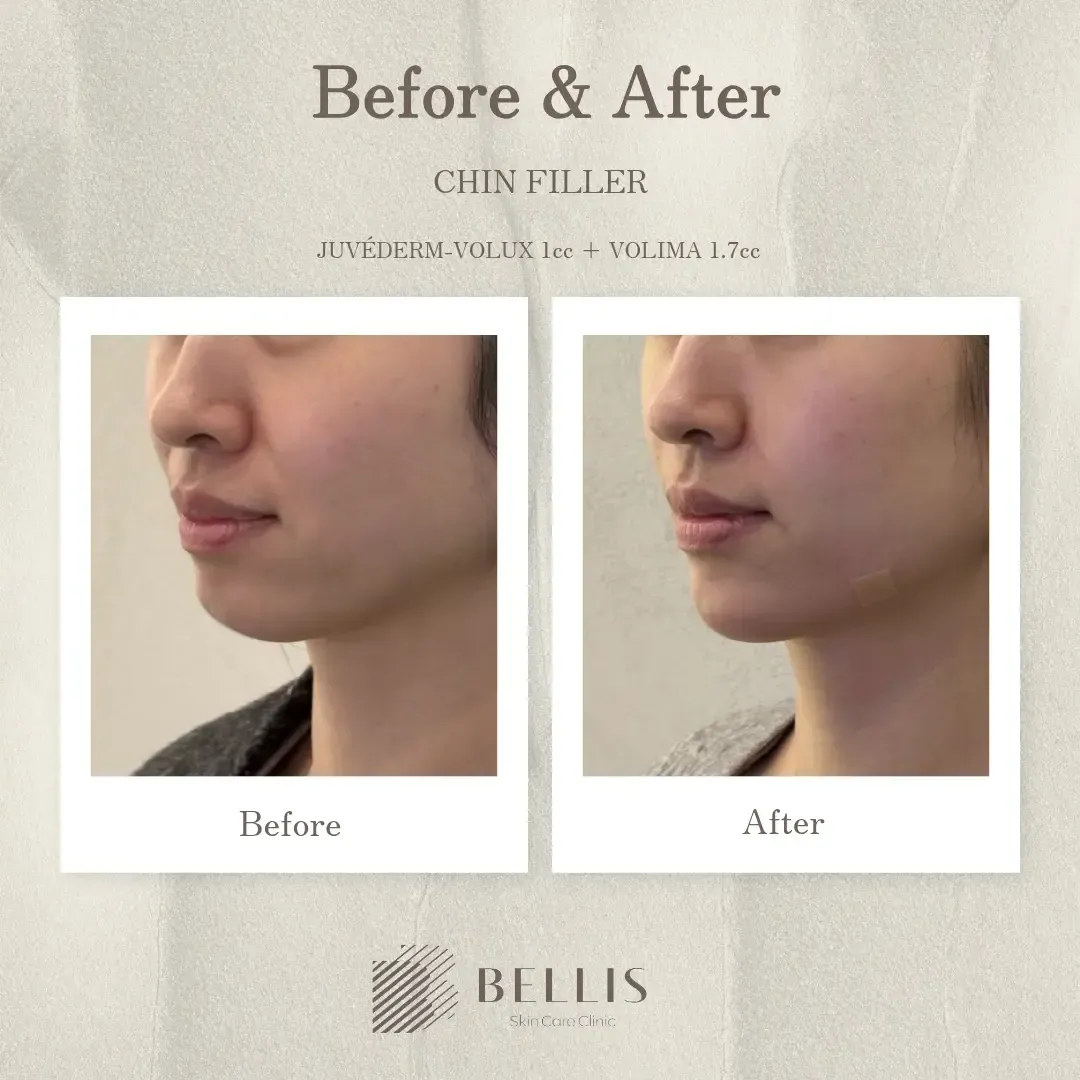 Chin filler side-profile before and after at Bellis Clinic