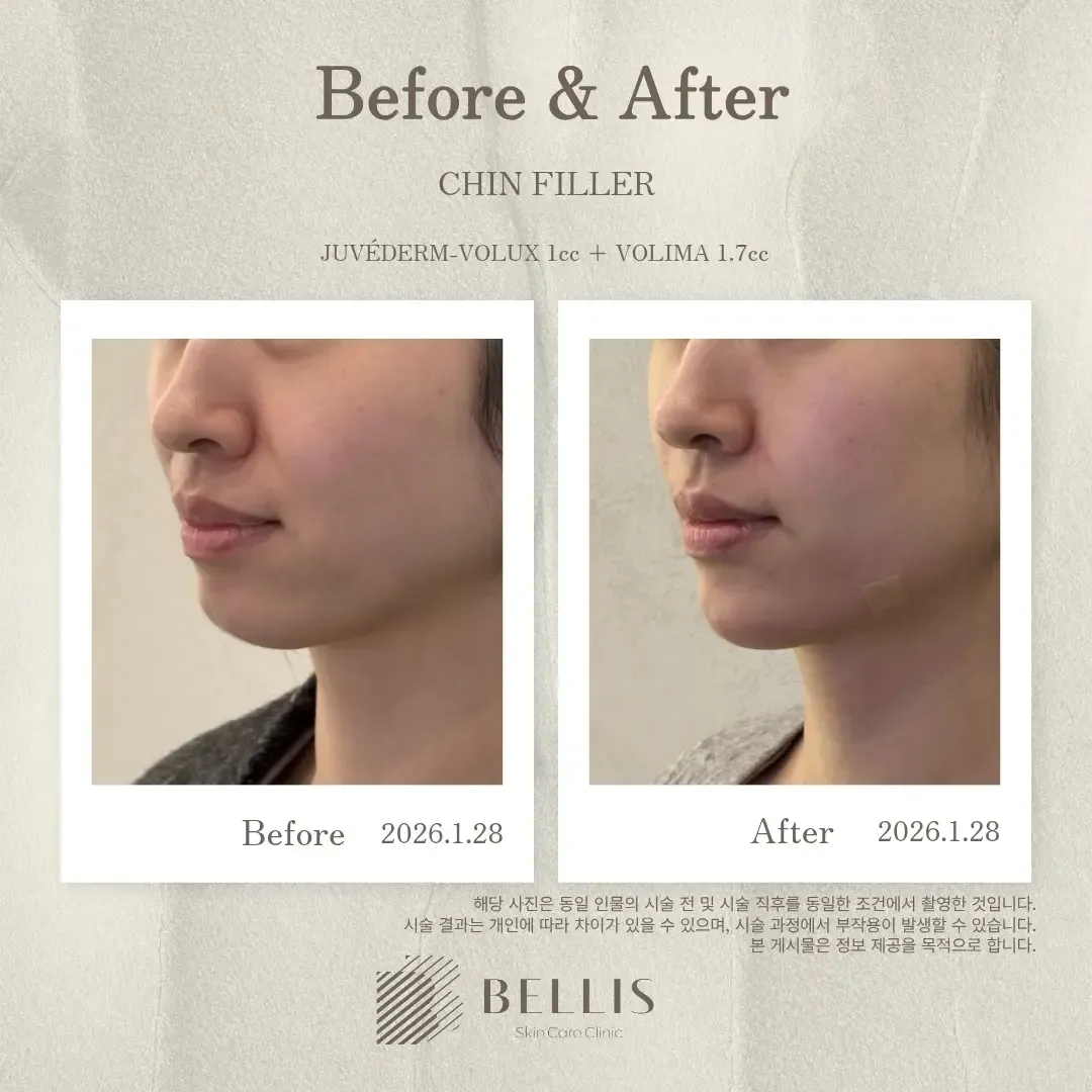 Chin filler profile before and after at Bellis Clinic
