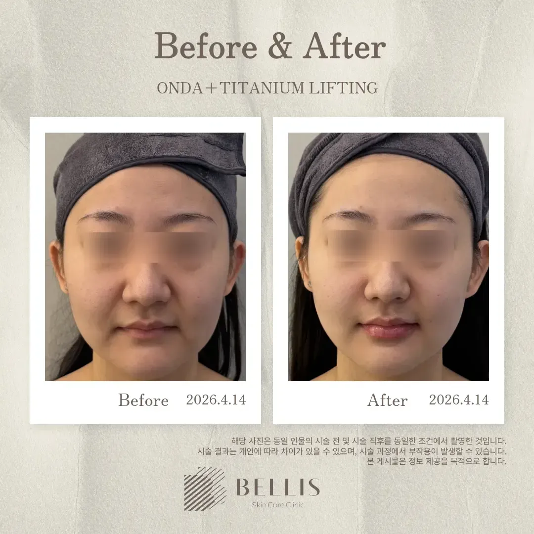 ONDA and Titanium lifting before and after at Bellis Clinic