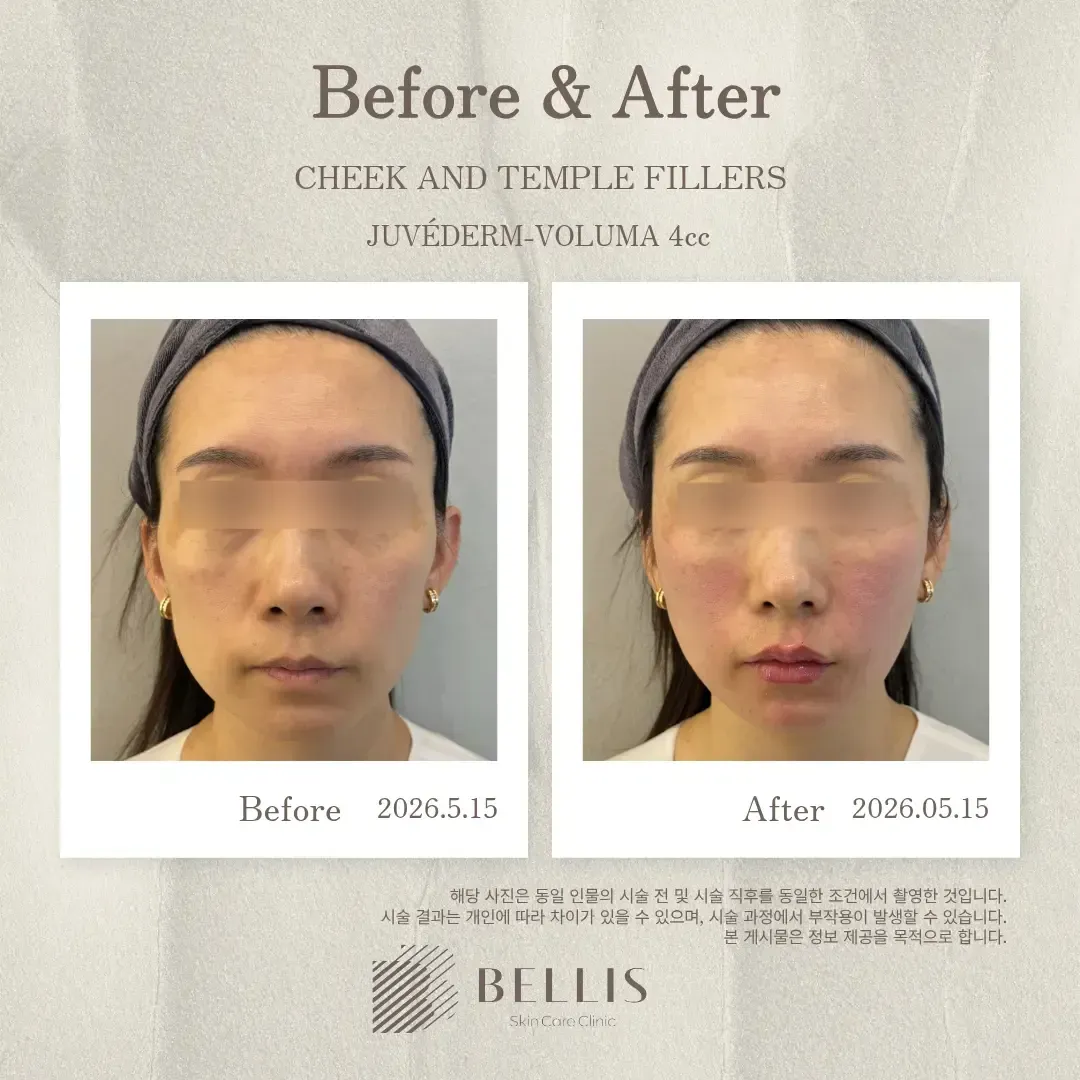 Anterior and lateral cheek filler before and after at Bellis Clinic