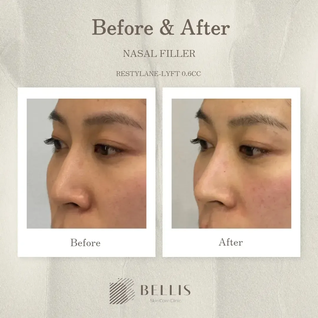 Nose filler profile before and after at Bellis Clinic