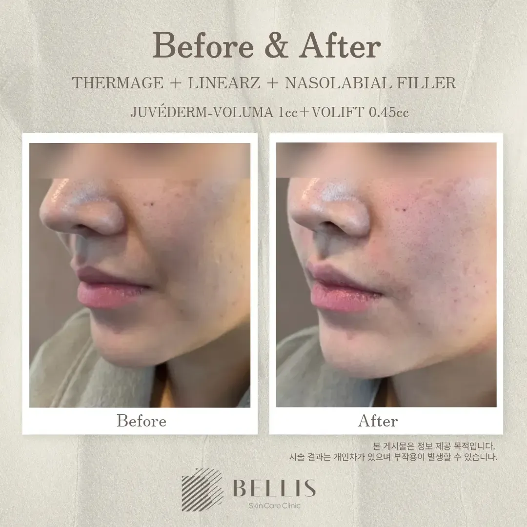 Nasolabial filler with lifting treatment before and after at Bellis Clinic
