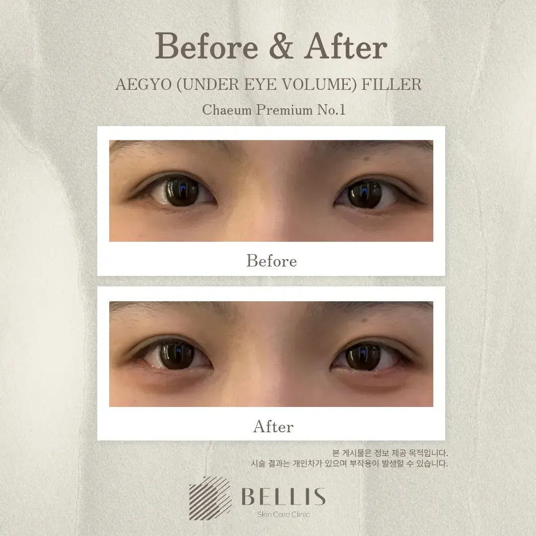Aegyo-sal and under-eye filler before and after at Bellis Clinic