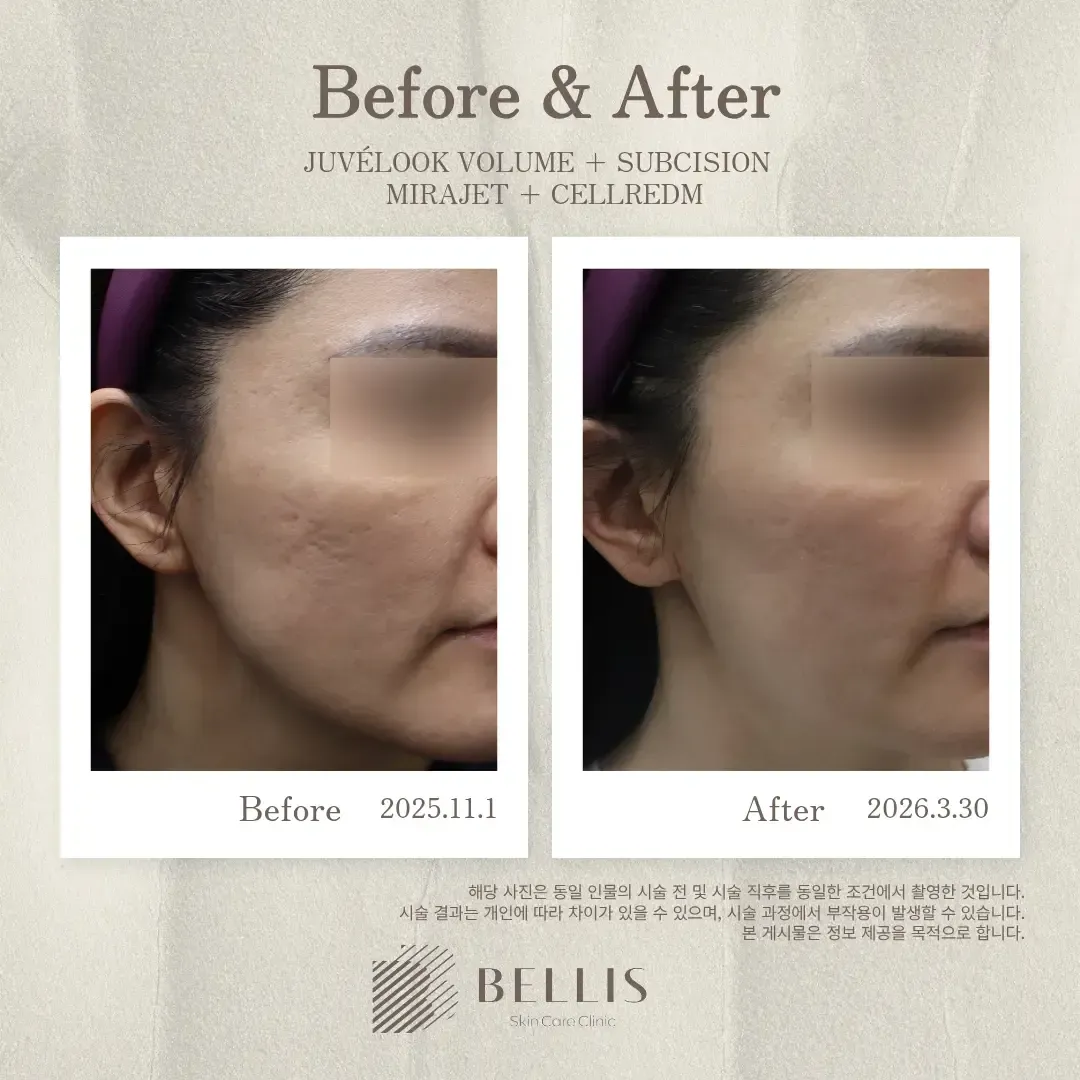 Juvelook Volume before and after at Bellis Clinic