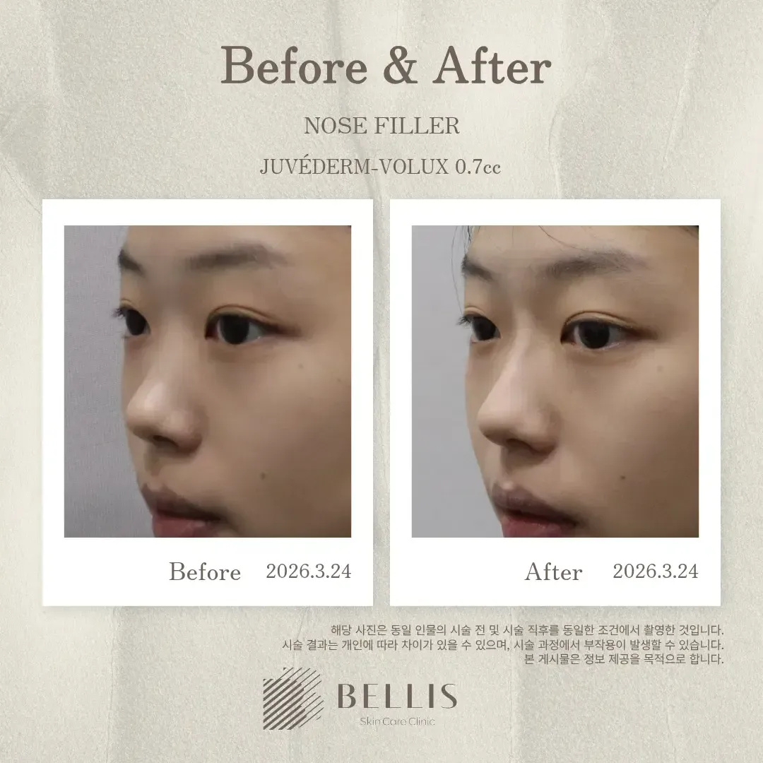 Nose filler oblique view before and after at Bellis Clinic