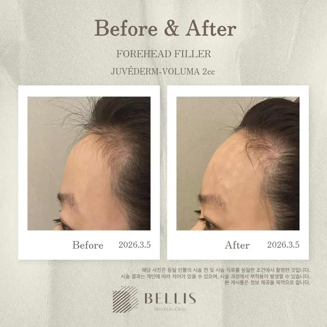 Forehead filler profile before and after at Bellis Clinic