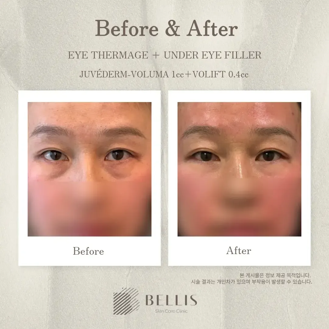 Eye Thermage FLX with under-eye filler before and after at Bellis Clinic