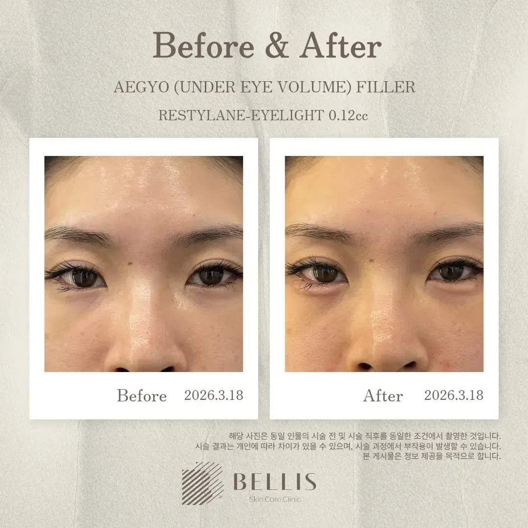 Under-eye and aegyo-sal filler before and after at Bellis Clinic