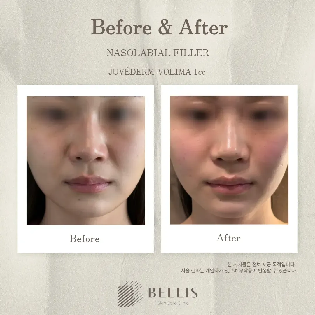 Nasolabial folds filler before and after at Bellis Clinic