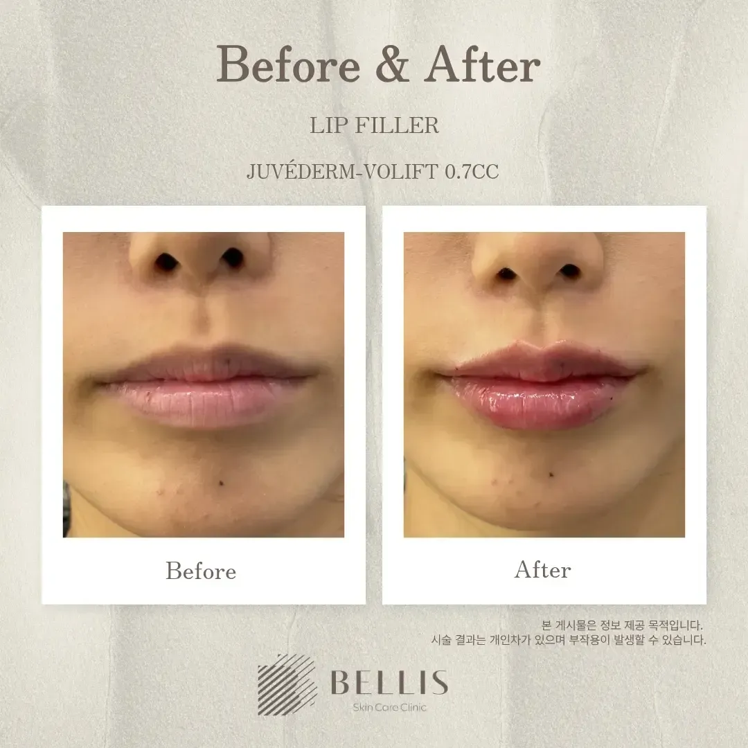 Natural lip-volume treatment before and after at Bellis Clinic
