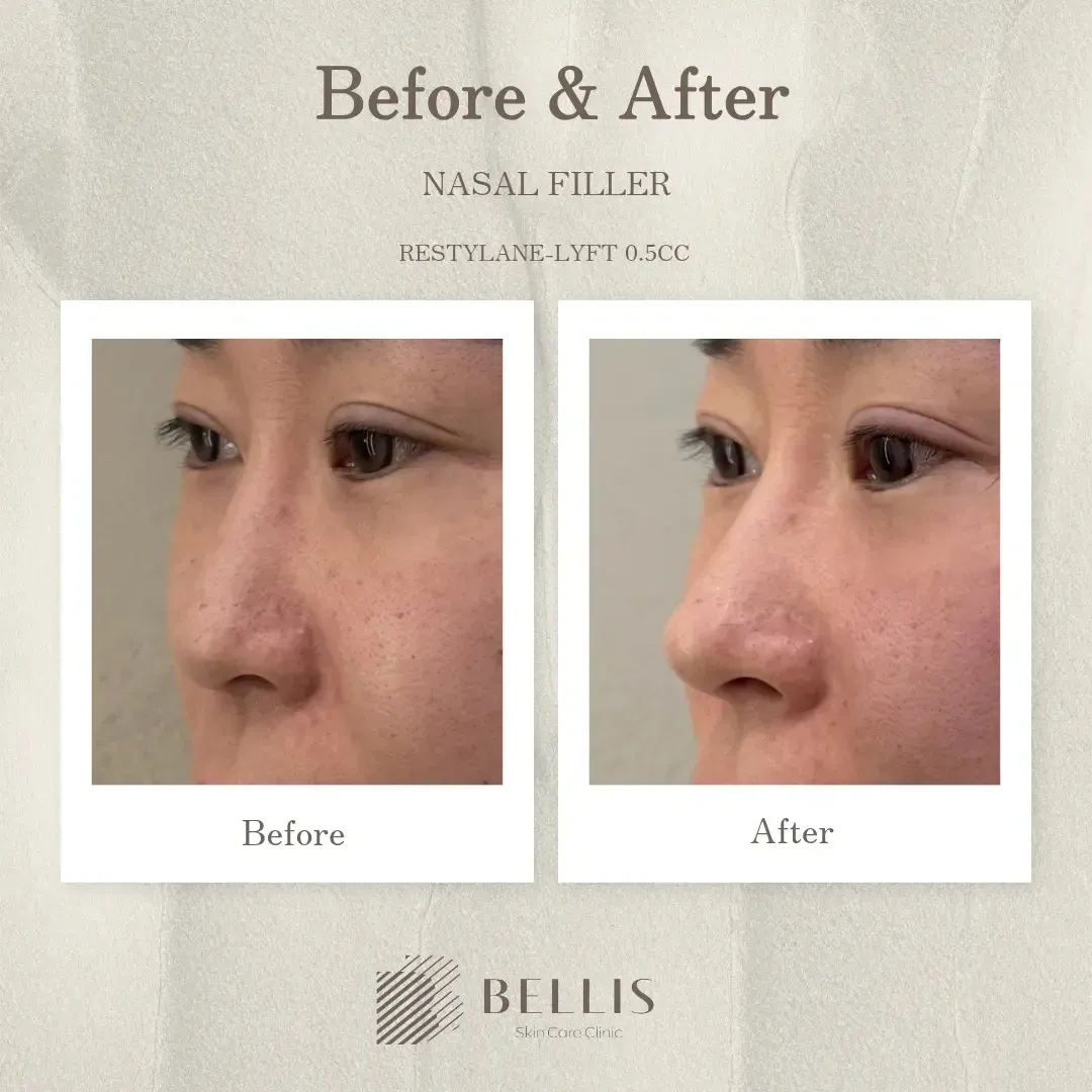 Nasal filler profile before and after at Bellis Clinic