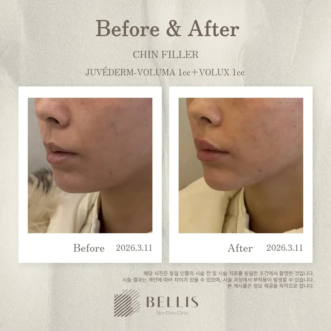 Chin filler with facial-profile planning before and after at Bellis Clinic