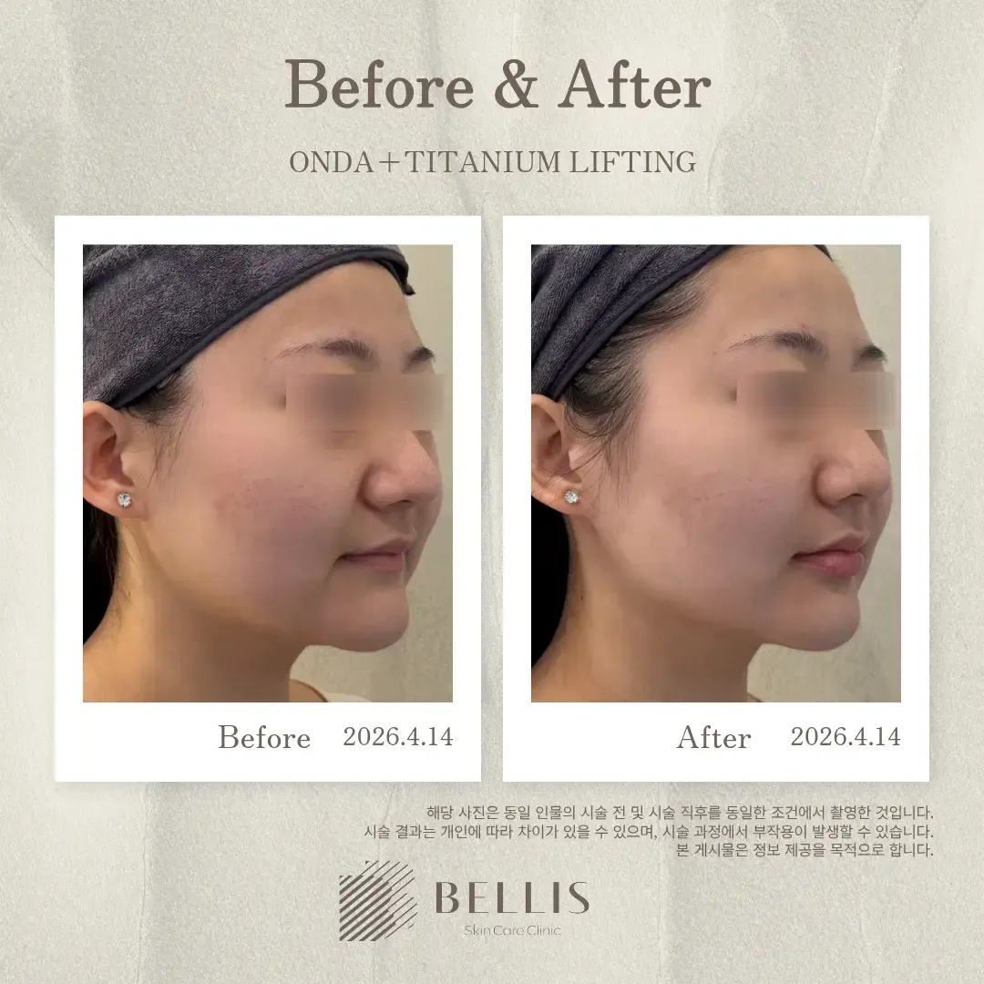 ONDA and Titanium lifting profile before and after at Bellis Clinic
