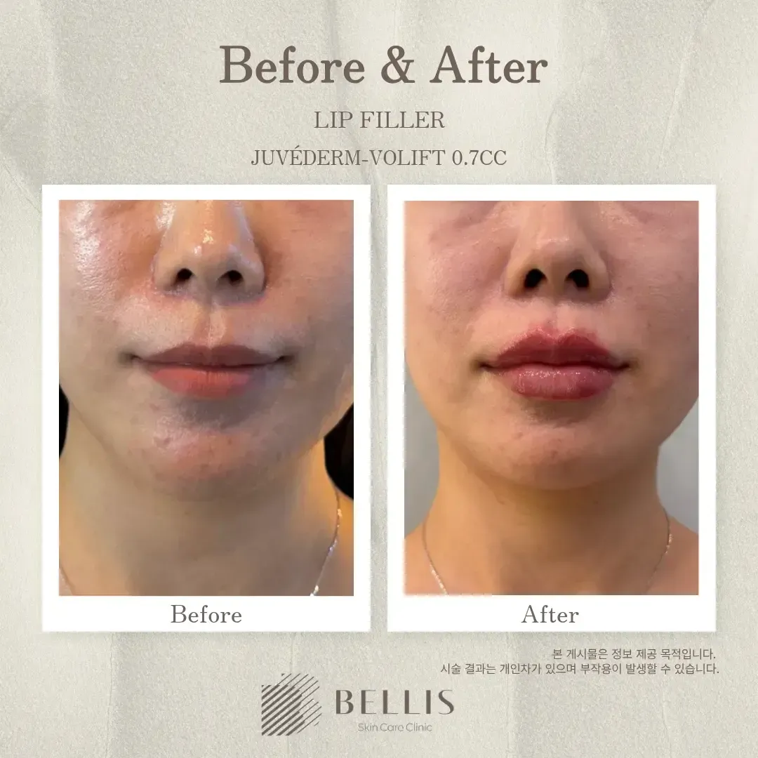 Lip filler frontal view before and after at Bellis Clinic