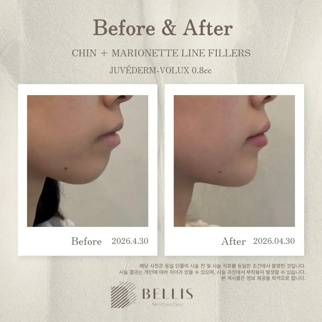 Chin and marionette-line filler before and after at Bellis Clinic