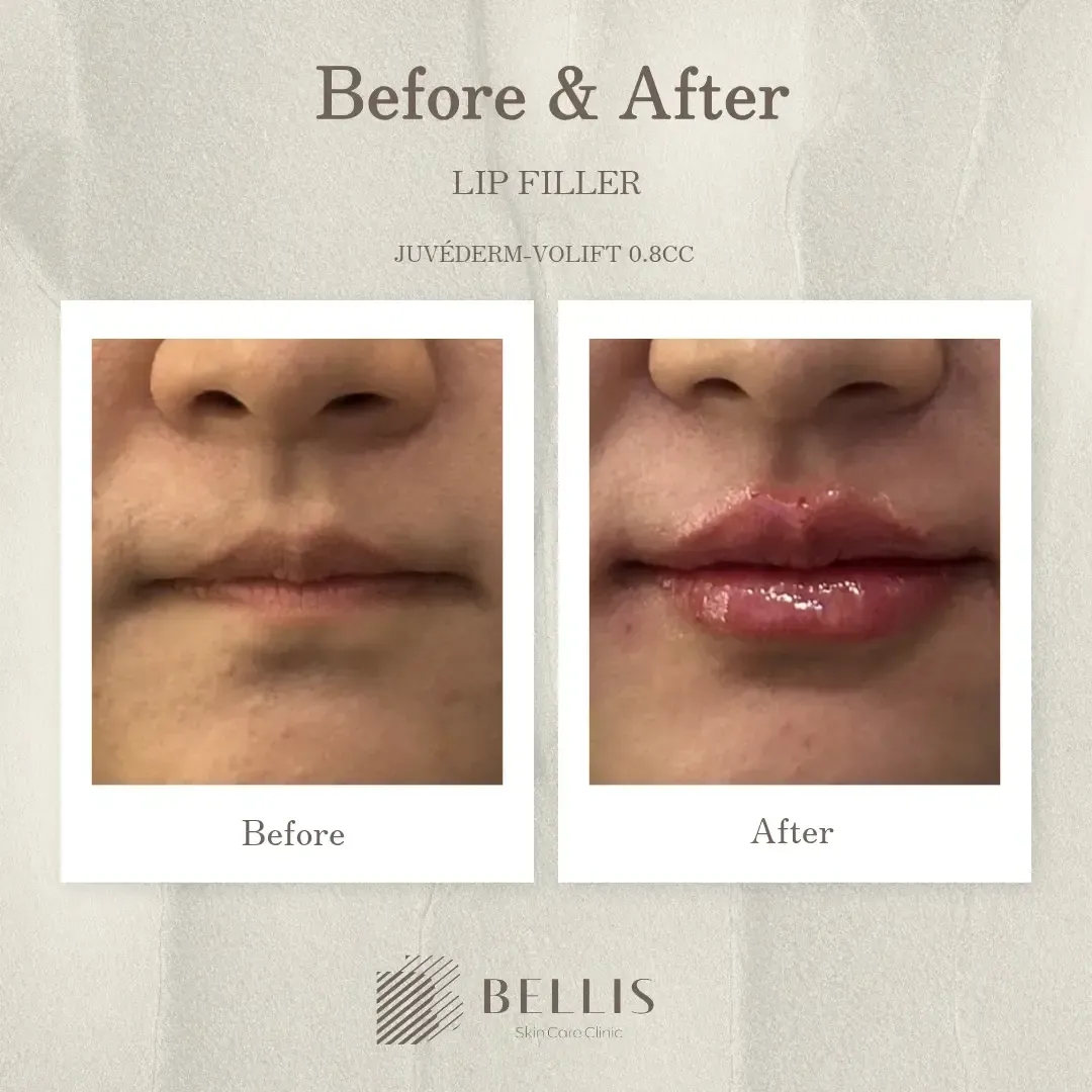 Juvéderm Volift 0.8 cc lip filler before and after at Bellis Clinic