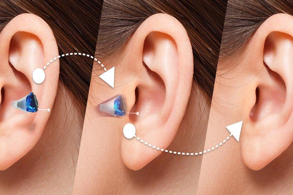Diagram shows the insertion of a blue hearing aid into a human ear.