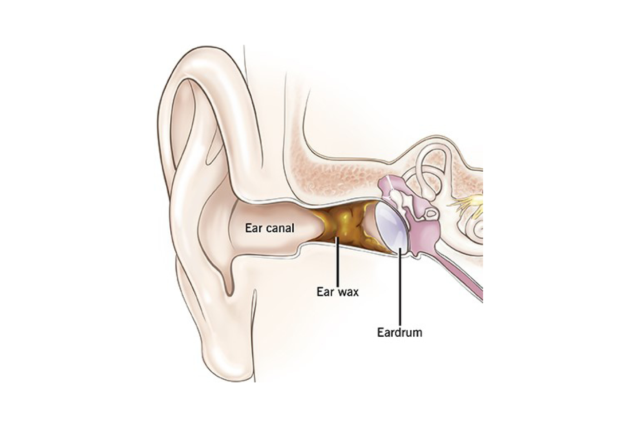 Cross-section of the human ear, showing the ear canal, ear wax, and eardrum.