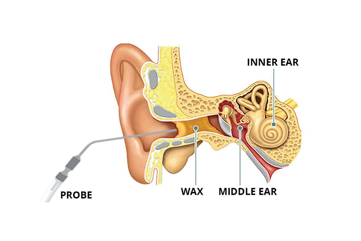 Cross-section diagram of the human ear, probe in ear canal labeled 