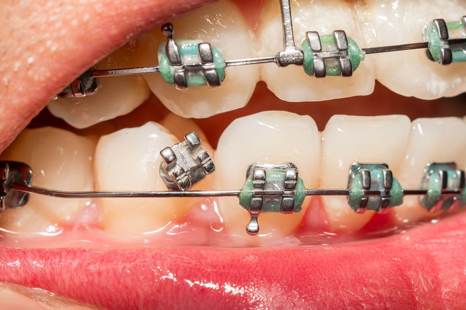 Teeth with metal braces showing brackets and wire during an orthodontic adjustment process Teeth with metal braces showing brackets and wire during an orthodontic adjustment process