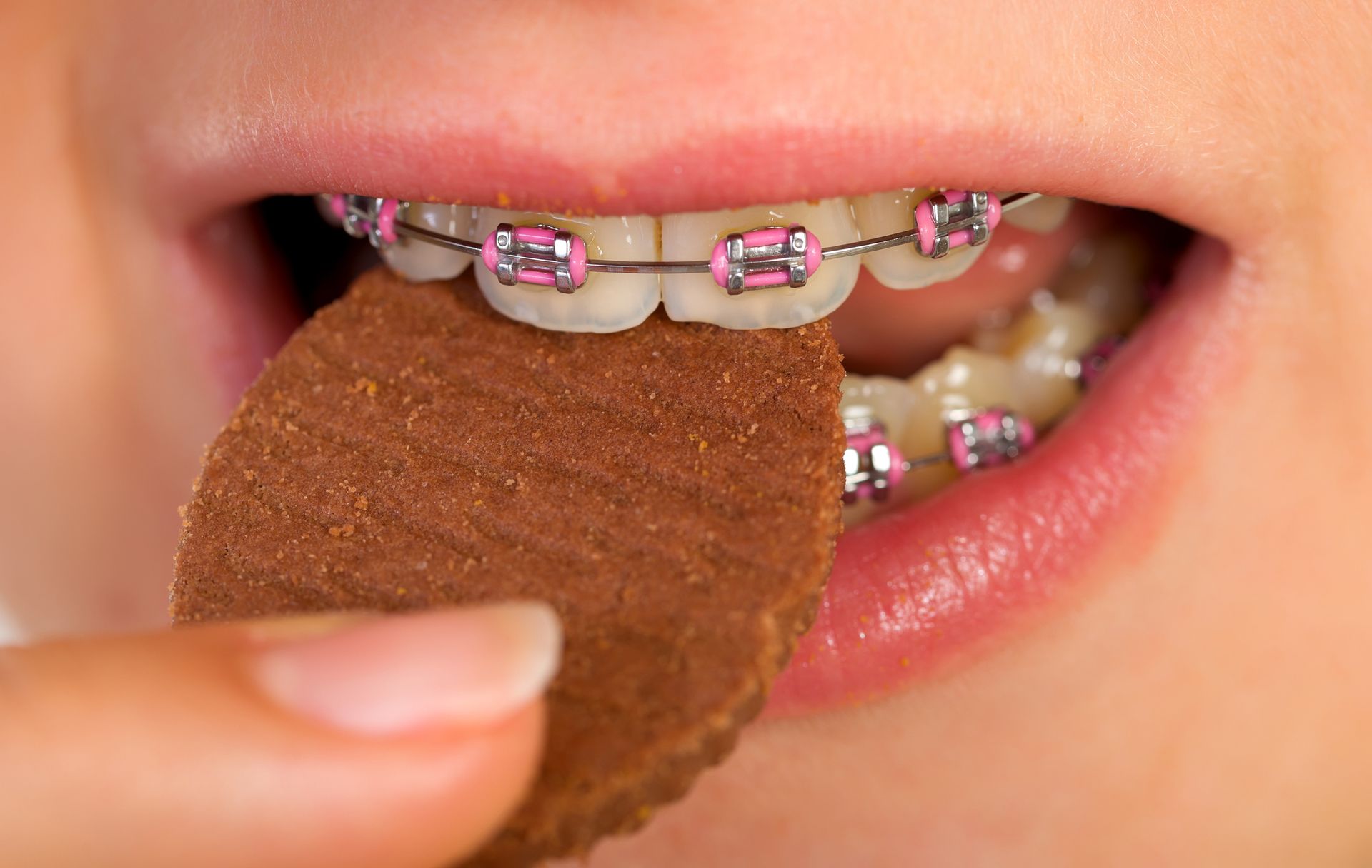 Braces Service