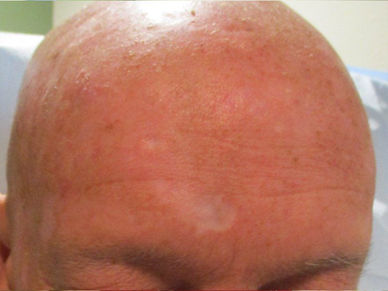 Fore Head