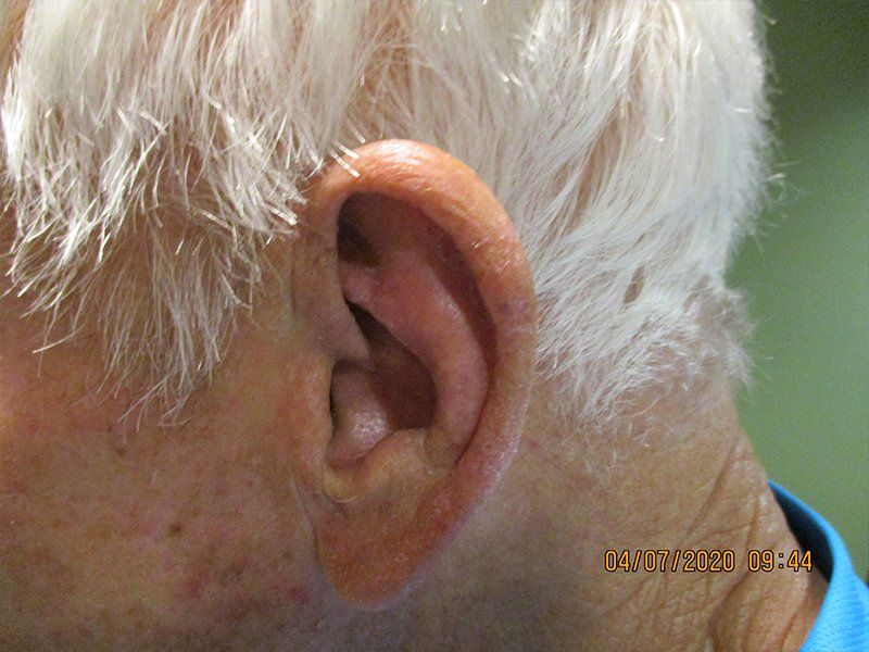 After Treatment
