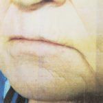 Lower Lip Cancer Lower Lip Cancer