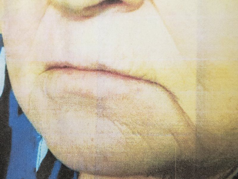 Left Lower Lateral Lip