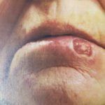 Lower Lip Cancer Lower Lip Cancer