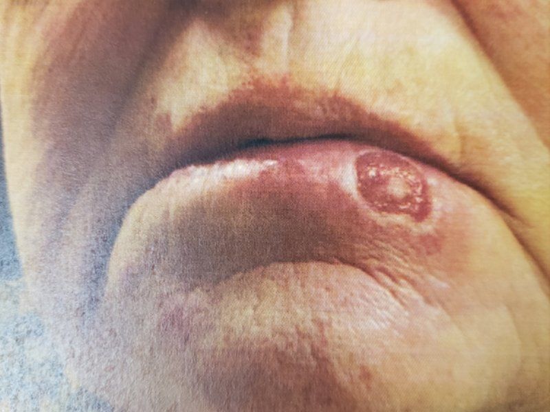 Left Lower Lateral Lip