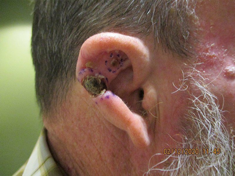 Right Ear