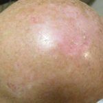 Skin Cancer Skin Cancer