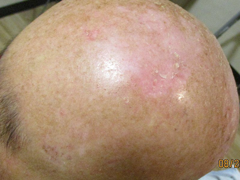 Right Scalp Vertex