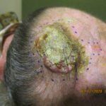 Skin Cancer Skin Cancer