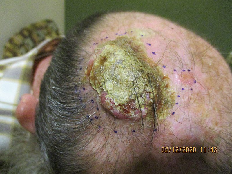 Right Scalp Vertex